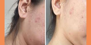 Best Dermatology Treatments for Acne-Prone Skin: A Simple Human Guide