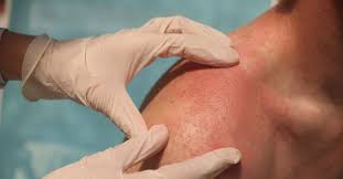 How to Choose a Certified Dermatologist for Eczema: A Simple Guide for Healthy Skin