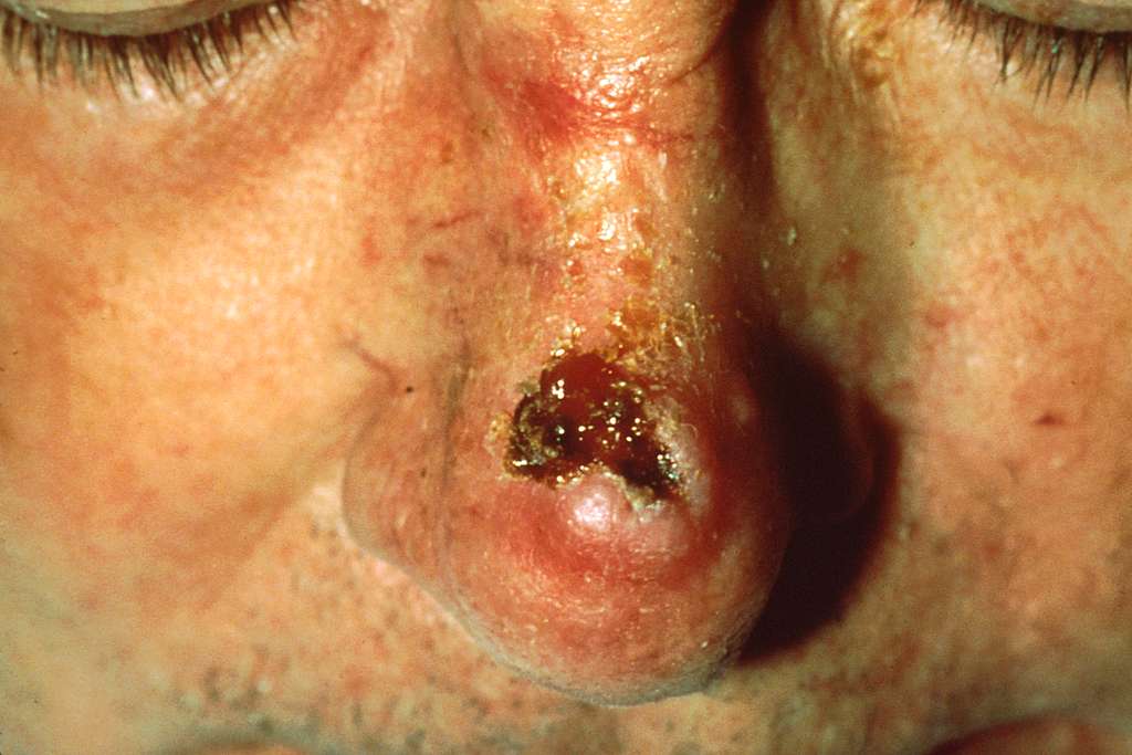 Identifying and Treating Skin Cancer