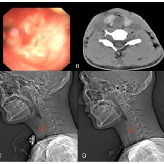 How Interventional Radiology Offers Minimally Invasive Tumor Ablation