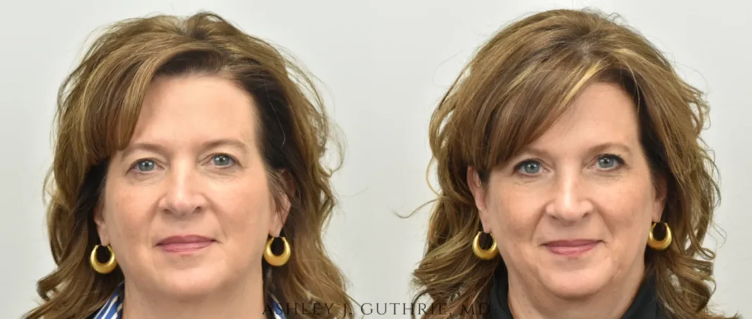 What Is Blepharoplasty and How Does It Work?