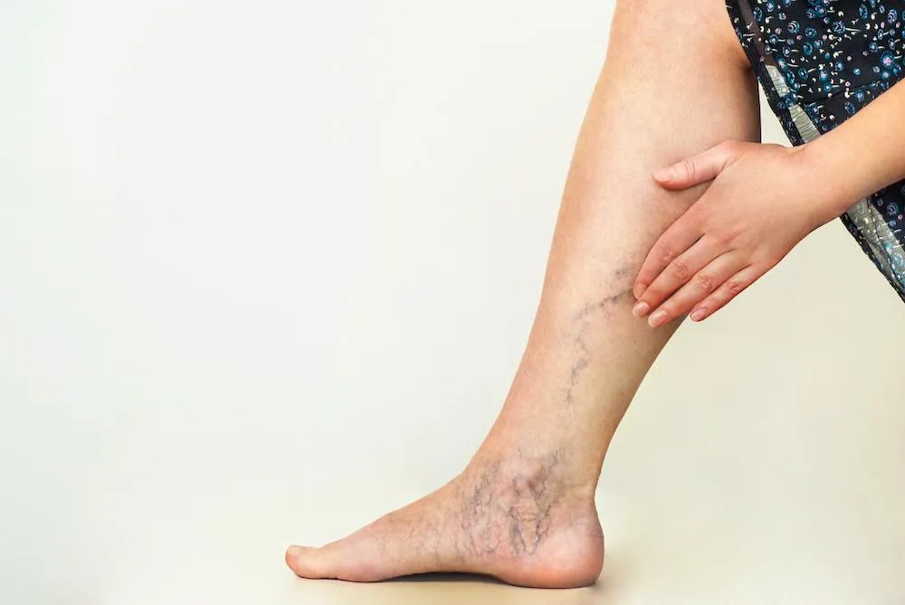 What To Know About Chronic Venous Insufficiency